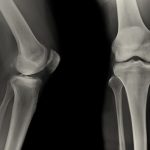 $687,207 medical negligence settlement after knee replacement